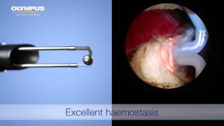 TURis 20  Bipolar Resection [upl. by Ina117]