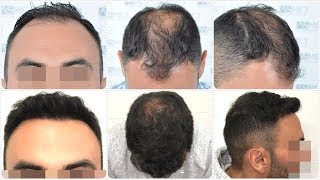 Manual FUE Hair Transplant Before amp After 5006 Grafts Result  ASMED  Dr Koray Erdogan [upl. by Charmine731]