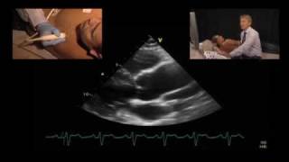 Echo Features of a Bicuspid Aortic Valve [upl. by Dougie]