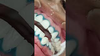 Appliquer du gel de blanchiment des dents [upl. by New]