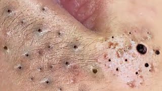 Big Cystic Acne Blackheads Extraction Blackheads amp Milia Whiteheads Removal Pimple Popping  9275 [upl. by Yzzik]