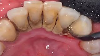 Tartar removal from teeth calculus remove [upl. by Kev]