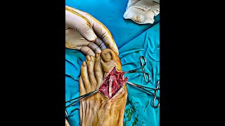 Extensor Hallucis Longus Laceration Repair [upl. by Jenelle]