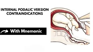 Internal Podalic Version Contraindications With Mnemonic  Obstetrics Mnemonics  Dr Mubashar Ata [upl. by Oirevlis]