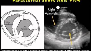 Anleitung Kardiologische Ultraschalluntersuchung – parasternal kurze Achse [upl. by Anilegna321]