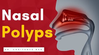 A to Z about Nasal Polyps  Sinus Expert talks [upl. by Mclyman]