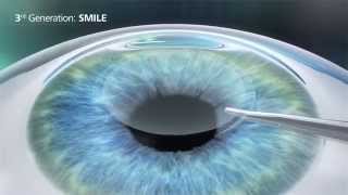 Relex SMILE versus LASIK versus PRK en LASEK [upl. by Aimahc]