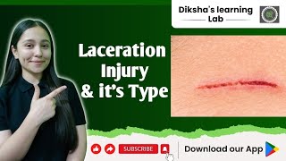 Laceration injury  Types of laceration injury  mechanical injury [upl. by Cirre870]