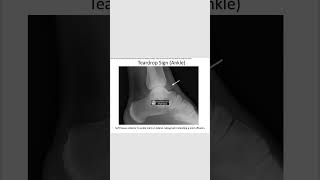 Teardrop signjoint effusionradiology orthopedics neetpg inicetshortsfeed [upl. by Eceined]