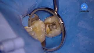 LiveEndo 4 Conductos Endodoncia paso a paso [upl. by Dionysus]