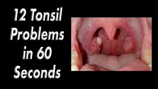 12 Tonsil Problems in 60 Seconds [upl. by Geanine]