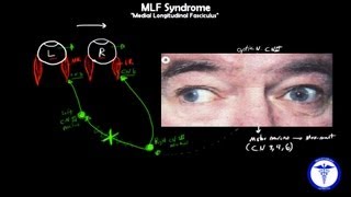 MLF syndrome  Internuclear Ophthalmoplegia MADE EASY [upl. by Baxy]