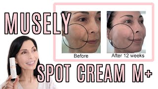 My Musely Spot Cream M Update With Before amp After Pictures of My Melasma [upl. by Jaycee]