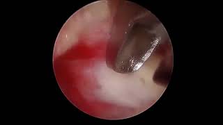 ULBD amp spiral fix with Biportal endoscpoic surgery [upl. by Aerdua208]