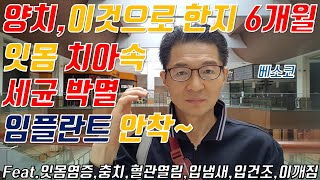 베소코 양치 구강 세균 없애고😁 임플란트 치조골 안착😃잇몸건강 치아튼튼 [upl. by Bois]