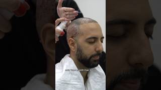 Hairs finally start growing after a hair transplant hairtransplant hairloss hairrecovery [upl. by Elleoj]