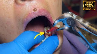 Abscessed Tooth Extraction in 1 MIN or less in 4K [upl. by Yleak]