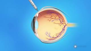 Eye Injections for Branch Retinal Vein Occlusion BRVO [upl. by Okire]