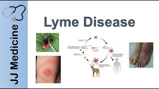 Lyme Disease  Pathophysiology Signs and Treatment [upl. by Enelrae333]