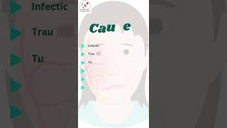 Know About Facial Nerve Palsy nerveloss facialnerveloss bellspalsy ghoshentfoundation ent [upl. by Dripps]