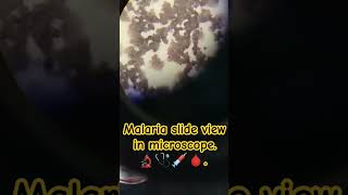 Microscopic view of malaria slide 🔬🩺💉🩸 malaria slide microscope diagnosis medicovibes medical [upl. by Felt978]