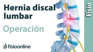 Hernia discal lumbar  Operación quirúrgica o cirugía [upl. by Bathsheb968]