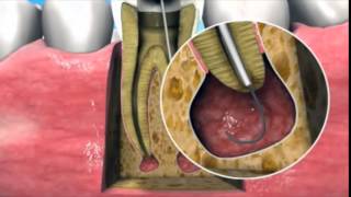 Nonsurgical management of periapical lesions [upl. by Weissman]