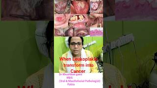 Is Leukoplakia transform to cancerWhen does leukoplakia turn into cancer White patch inside mouth [upl. by Enimzaj274]