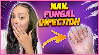 How I got a nail fungal infectionand treated it [upl. by Bluh]