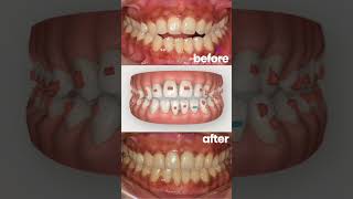 Open Bite  Cross Bite correction in adults with Invisalign orthodontist invisalignbeforeandafter [upl. by Ahsiram471]