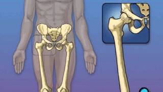 Hip Replacement Surgery PreOp® Patient Education [upl. by Philbin]