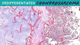 Dedifferentiated Chondrosarcoma with osteosarcoma heterologous area  hemipelvectomy UNC case 7 [upl. by Erle]