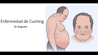 Hipercortisolismo Síndrome de Cushing y Enfermedad de Cushing [upl. by Noma]