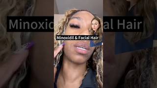 Minoxidil Gave Her A Beard dermreacts [upl. by Weeks]