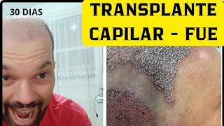 TRANSPLANTE CAPILAR  FUE APÓS 30 DIAS [upl. by Michaela965]