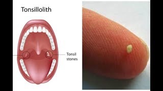 Tonsilloliths tonsil stones a patient education video by Carlo Oller MD [upl. by Blount]