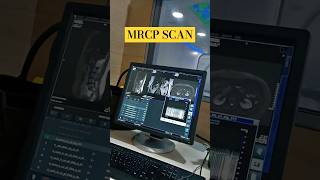 MRCP SCAN MRI radiologycareer viralshortbscradiologymriscan trendingshortsviraltrendingshorts [upl. by Nahk]