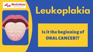 Leukoplakia l Precancerous lesions l Oral pathology l Mediklaas [upl. by Hort459]