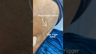 Watch a massive trigger points released [upl. by Odlonyer]