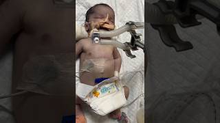 Newborn serious condition🥺 ventilator supportnewbornbaby healthcarenicushorts ytshortsindia [upl. by Fredrika802]