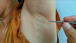 PLUCKING INGROWN UNDERARM HAIR and spit armpit hair for ms Kien asmr [upl. by Nehgam]