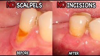 Gum Recession Causes amp Treatment The Pinhole Technique [upl. by Cherie286]