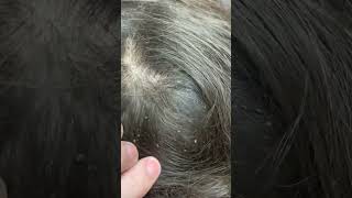 Picking a thousand of lice on hair How to get rid of lice licetok nits piojos kuto kutu lice [upl. by Servetnick]