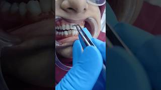 Braces treatment dentist dentalsmiledesigning dentaltreatment smiledentist dentalclinic smile [upl. by Lever865]