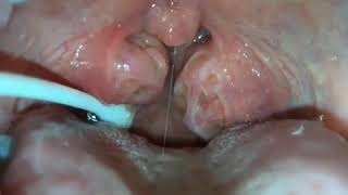 How to remove caseum from your tonsils [upl. by Oirramed678]