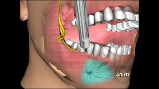 ментальная анестезияmental anesthesia [upl. by Conall816]