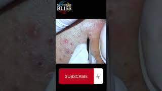 how to remove the blackheads pimple [upl. by Enelrats651]