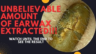 UNBELIEVABLE Amount Of Earwax Extracted From This Ear Watch Until The End [upl. by Niad]