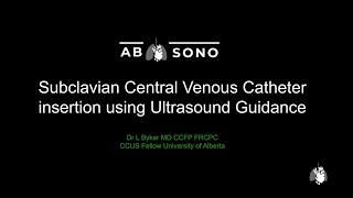 Ultrasoundguided subclavian venous access [upl. by Assehc549]