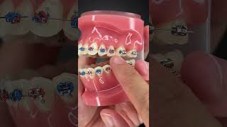 How to Floss Properly with Braces On [upl. by Ahsinhoj234]